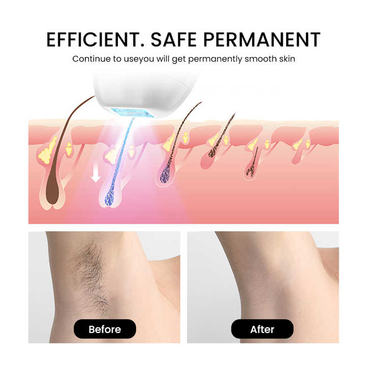 IceCool IPL Laser Hair Removal Handset – Painless At-Home Hair Removal with Sapphire Ice Technology | 6 Colors | 400,000 Flashes